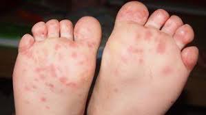 L'alimentation de l'enfant la gorge et la bouche de l'enfant sont fragilisées : Pieds Mains Bouche Causes Symptomes Traitements Minimall