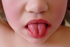 Image result for Scarlet Fever