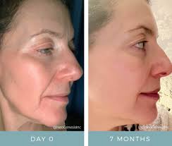 Hyperkeratosis Before + After NeoGenesis Recovery Serum