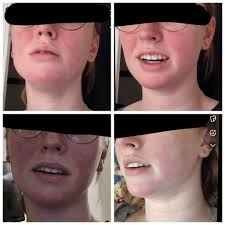 MCAS? Rosacea? Lupus? : r/MCAS