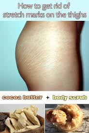 How To Get Rid Of Stretch Marks On The Thighs Stretch Marks Health And Beauty Tips Beauty Recipe