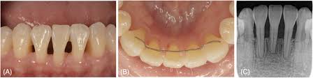 Récession gingivale avec exposition radiculaire — vue clinique