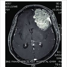 The first step in detecting a brain the pet scan may also be helpful if your doctor is having difficulty determining whether the mri or ct scan shows a tumor or scar tissue in your brain. Brain Ct Scan Showing A Large Brain Tumor Involving The Left Frontal Download Scientific Diagram