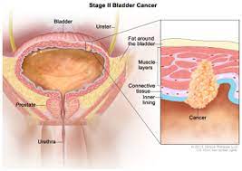 Pundi kencing atau (bladder) merupakan satu organ otot lopong yang menyimpan air kencing sebelum menyingkirkannya dari tubuh. Kanser Pundi Kencing Pusat Sumber Dan Pendidikan Kanser Care