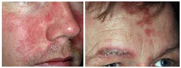 Vissa läkemedel kan orsaka hudutslag hos vissa människor. Mjalleksem Seborroiskt Eksem 1177 Vardguiden