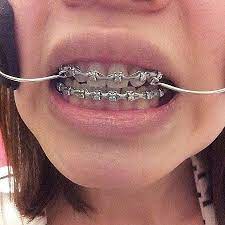 Pin By Thor On Orthodontic Headgear Dental Braces Fake Braces Cute Braces