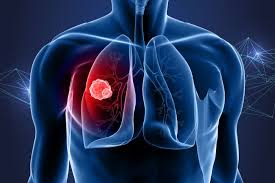 Image result for Lung Cancer