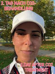 dresassassi #plastischechirurgieluxembourg #antiaging #fillers  #frischesaussehen #co2laser