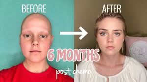 Chemotherapy can cause hair loss on your scalp, eyebrows, eye lashes, arms, legs, and pubic area. 6 Months Post Chemo Hair Growth Youtube