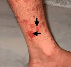 Image result for Auspitz Sign