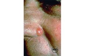Image result for skin cancer on nose pimple