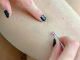 Here's how to pop an infected ingrown hair. Ingrown Hair On Legs Removal And Prevention