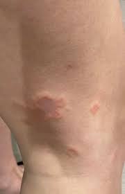 Image result for Eczema nummulare