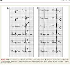 Image result for Early Repolarization