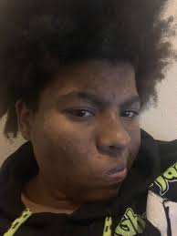 can any of you ladies help me out w how to lighten or get rid of acne scars  i absolutely hate my face i broke out so much when i was pregnant