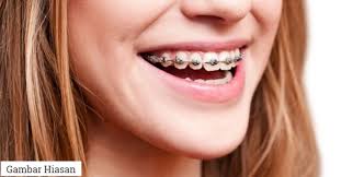 Maybe you would like to learn more about one of these? Rimas Pakai Braces Lama Lama Ini Sebab Kenapa Anda Perlu Pakai Pendakap Gigi Dalam Tempoh Yang Lama