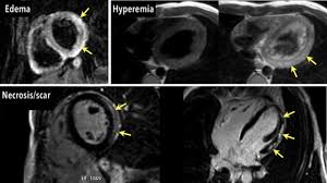 Learn more about myocarditis or inflammation of heart muscles, possible causes, symptoms, treatment, personal experiences. Cardiac Magnetic Resonance Assessment Of Myocarditis Circulation Cardiovascular Imaging