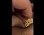 Bartholin Cyst Popped On Its Own