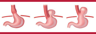 In fact, the most common cause of esophageal ulcers is gerd or acid reflux. Laparoscopic Anti Reflux Gerd Surgery Patient Information From Sages