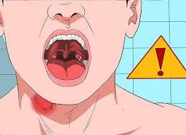 Fiebre, faringitis y amigdalitis exudativa. Doctiplus La Mononucleosis Infecciosa Es Una Enfermedad Facebook
