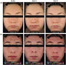 This concave appearance is due to a sudden loss of collagen. Adapalene 0 3 May Help Improve The Appearance Of Atrophic Acne Scars Kindofstephen
