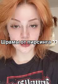 Шишка На Губе Внутри Прокола