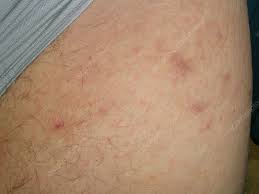 Image result for scabies in the groin area