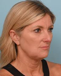 Fat Transfer Before & After Photos