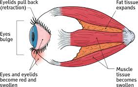 Take a look at her profile , her journals and her pictures. Phases Of Thyroid Eye Disease Tepezza Teprotumumab Trbw