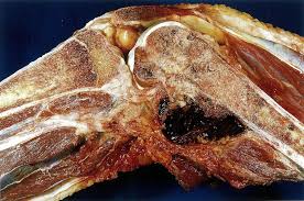 Pharmacodynamics the treatment of diseases, such as infectious diseases and cancers, through the application of knowing the general properties of drugs (their action, both beneficial and harmful) is. Malignant Bone Tumors Amboss