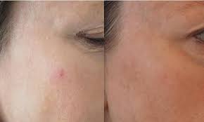They include alpha hydroxy acids, such as lactic acid, and beta hydroxy acids (bhas), such as salicylic acid. Removing A Red Spot On The Face Best Clinic Sydney For Dermal Fillers