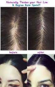Hair Growth Bald Spots Olive Oils 23 Ideas For 2019 Grow Long Hair Hair Thickening Longer Hair Faster