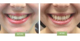 Can invisalign close the gaps between your teeth and improve. Invisalign For Open Bite Does Invisalign Work For Open Bites