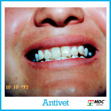 Antivet Case Studies Antivet kit its the perfect ally for eliminate stains due tofluorosis, smoking cigarette or drinking dark antivet® kit is also recommended as a pre ortho treatment to have better bracket adhesion in dental. antivet case studies
