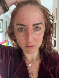 Radiation rash after breast cancer treatment