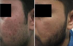 Image result for Postinflammatory Hyperpigmentation