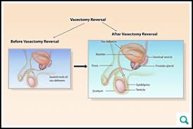 Image result for Vasectomy