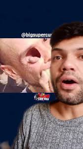 O bizarro caso de Billy Owen😳😳😳 #bizarro #cancer #fatosreais #foryou #fy