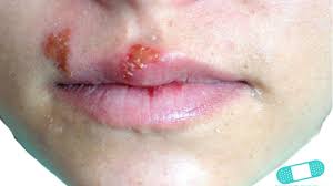 Infection with herpes simplex virus type 1 causes cold sores. Oral Herpes Simplex Cold Sores