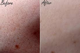Best Treatment For Acne Rosacea Shrinking Pores On Your Face Causes Of Acne Lancaster Elizabethtown Pa