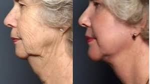 All surgical procedures come with some amount of risk and must be treated as such. How Much Does Chin Augmentation Cost Raleigh Chin Augmentation Stein Plastic Surgery