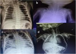 Soft decrease in transparency with an aerobronchogram, which overlaps the heart (= always a sign of an alveolar lung reaction. Respiratory Distress And Management Strategies In The Newborn Intechopen