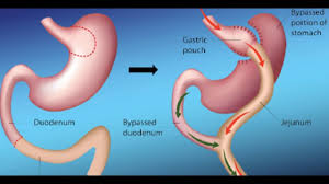 Pin On Laparoscopic Sleeve Gastrectomy Surgery