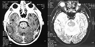 If your cancer hasn't spread to other parts of the body, it might also be given a risk group. Neurologic Complications Of Prostate Cancer American Family Physician