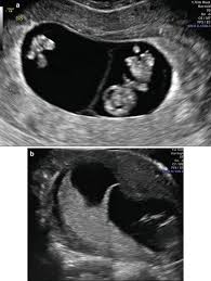 Image result for First Trimester Ultrasound