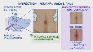 Assessment of Anus, Rectum, and Prostate - Osmosis Video Library