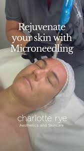 Microneedling stimulates your body’s own natural collagen and elastin,  improving skin firmness, texture, and elasticity., Microneedling induces a  rejuvenating response that over a series of treatments ...