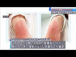 (5) ワクチン接種との因果関係（報告者の評価） 関連あり 報告者意見：18 歳時に化粧品を塗付した部位に強い発赤・湿疹の出現があったこ とが、入院後の追加の問診で判明した。pegへの感作が疑われる。 他要因の可能性の有無：無 ãƒ¢ãƒ‡ãƒ«ãƒŠç¤¾ãƒ¯ã‚¯ãƒãƒ³ ä¸€éƒ¨ã§ æ¹¿ç–¹ ã®ã‚ˆã†ãªåå¿œ 2021å¹´3æœˆ6æ—¥ Youtube