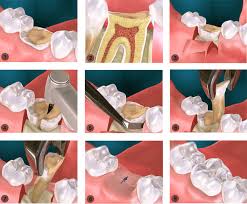 Image result for Tooth Extraction