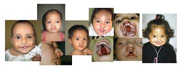 Image result for Cleft Lip